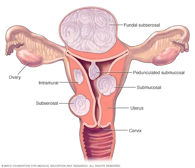 What is the best treatment for submucosal fibroids?