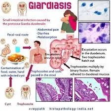 What Is the Best Diet for Recovering from Giardiasis?