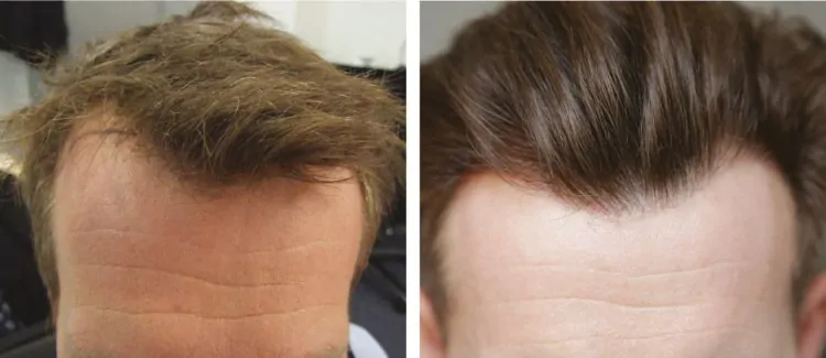 Expert Advice from a Leading Hair Transplant Clinic in London